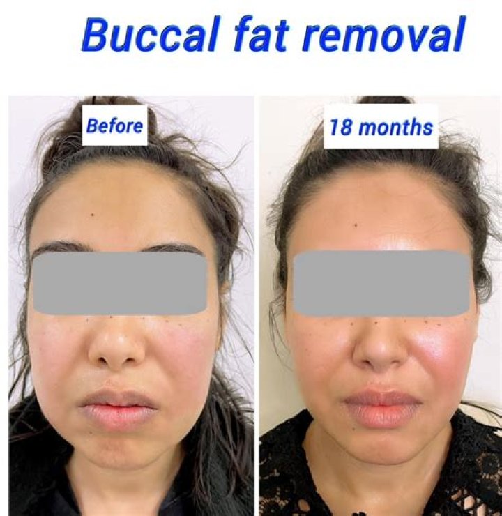 Fat removal procedure for short