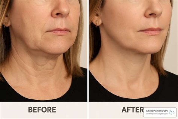 Fat-suctioning cosmetic procedure for short