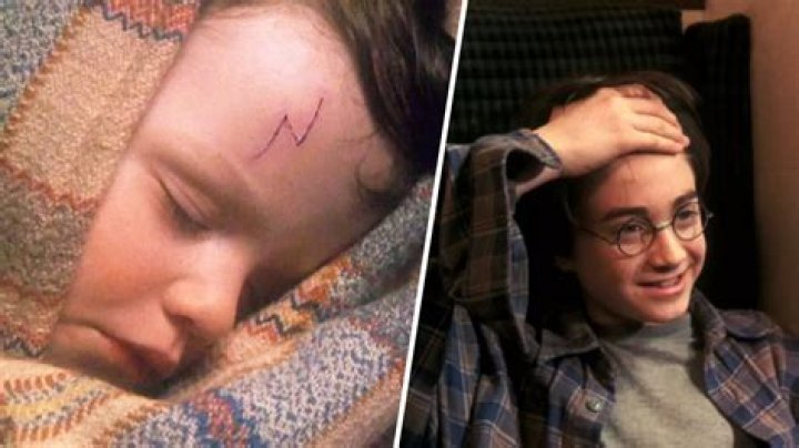 Feature on Harry Potter's forehead