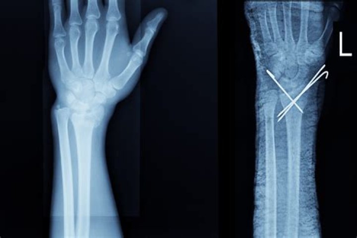 It immobilizes a broken wrist