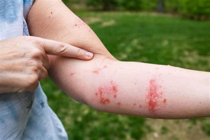 Itchy outbreak caused by poison ivy