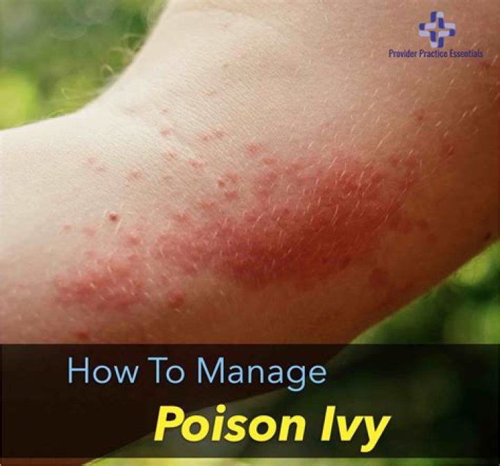 Itchy problem caused by poison ivy