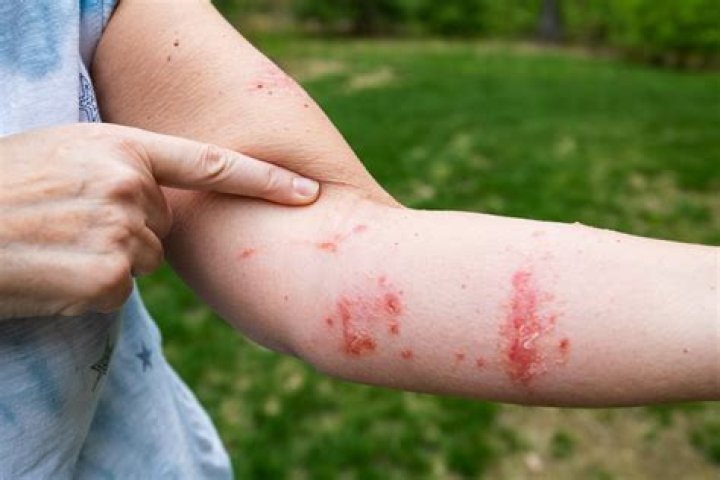 Itchy reaction to poison sumac