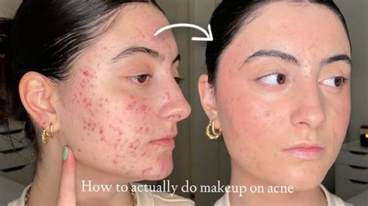 Like acne-free skin