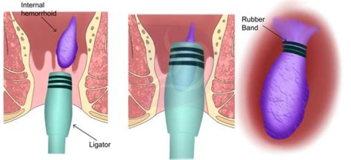 Part of a lobster that might have a rubber band around it while in a restaurant's tank