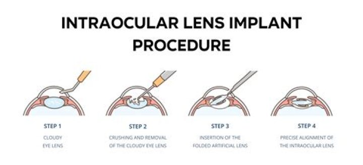 Place for a contact lens