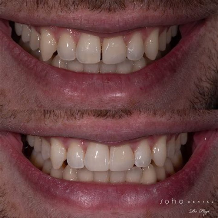 Space between front teeth
