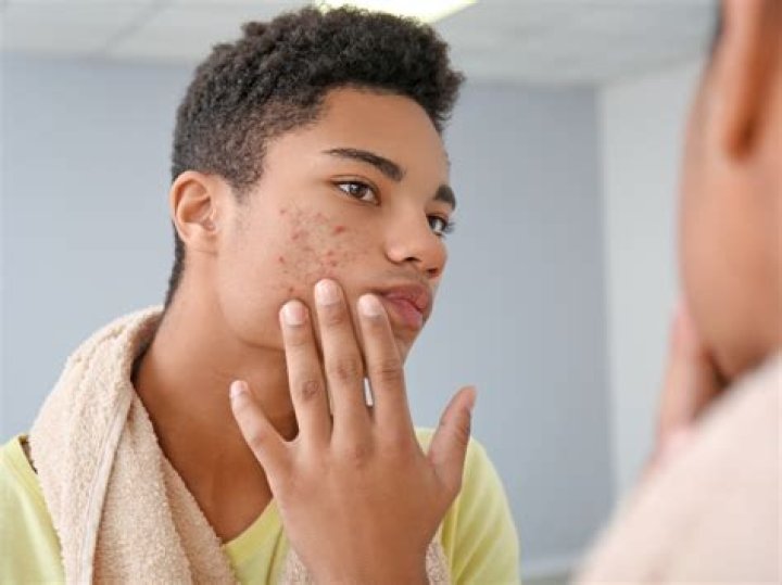 Teenager's skin spots