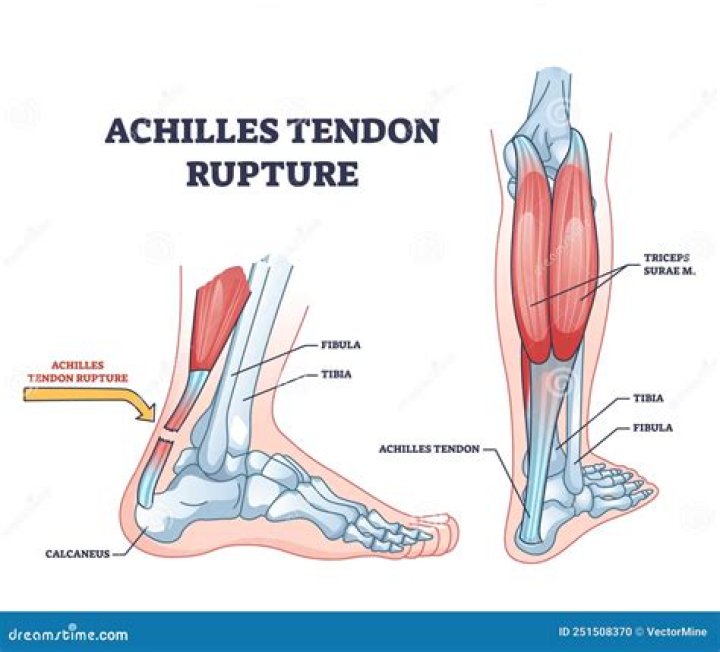 Vulnerable body part for Achilles